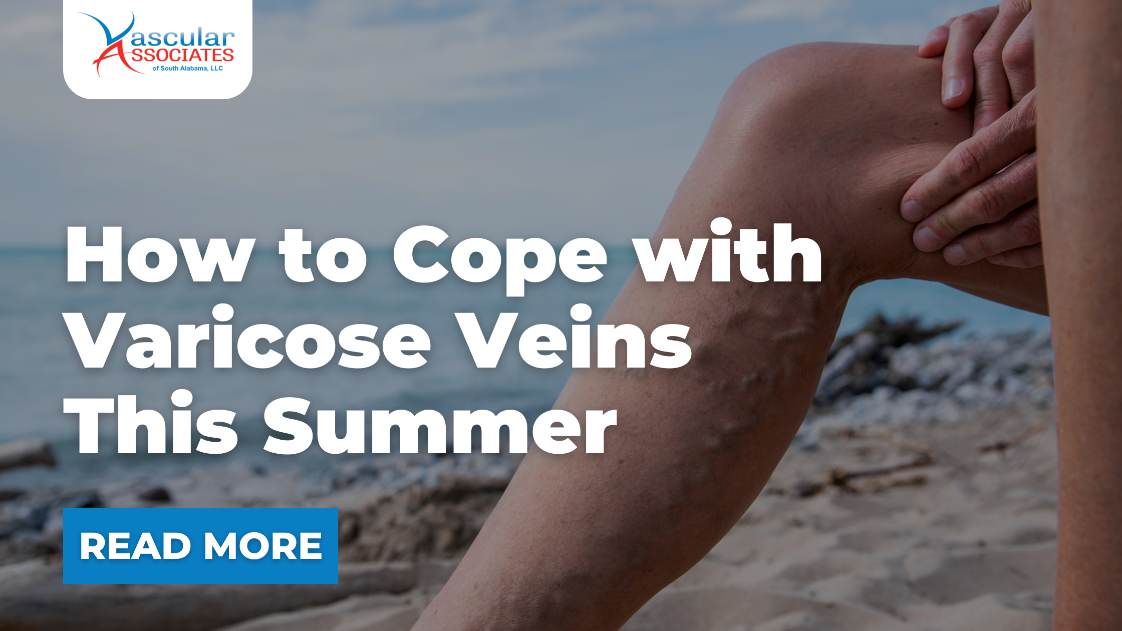 Vascular Blog - How to Cope with Varicose Veins This Summer.png